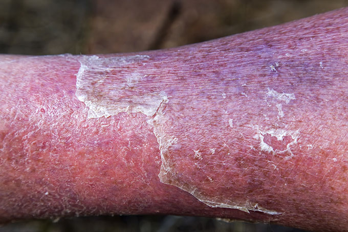 Complications of Untreated Varicose Veins #2: Cellulitis 13 Complications of Untreated Varicose Veins and Venous Insufficiency Cellulitis