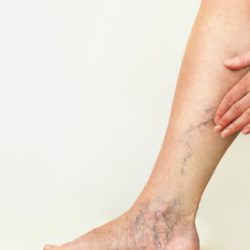 venous reflux disease were found on the ankles