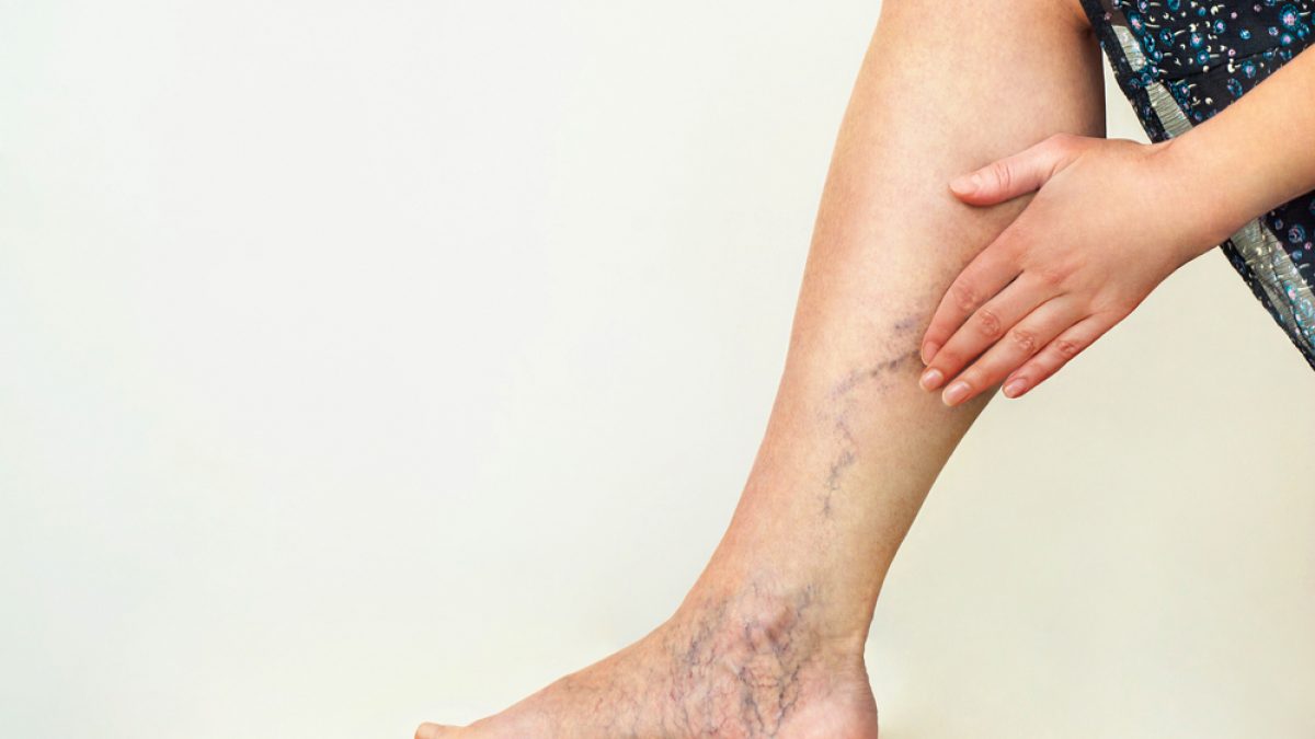Complications of Varicose Veins #6 Darkening of the Skin Complications of Varicose Veins