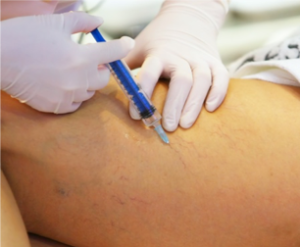 image of cryosclerotheraphy procedure