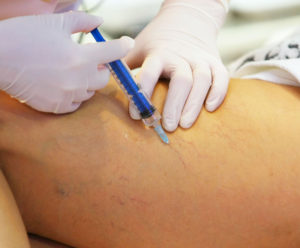 Injecting Foam Sclero