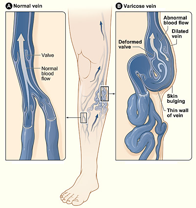 Varicose_veins Diagram showing the details of Varicose veins