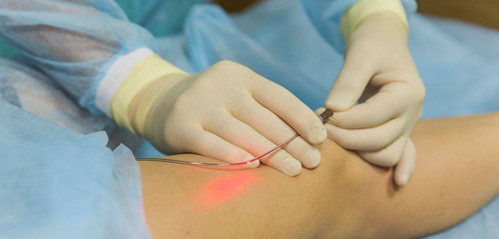 How Laser Vein Ablation Works