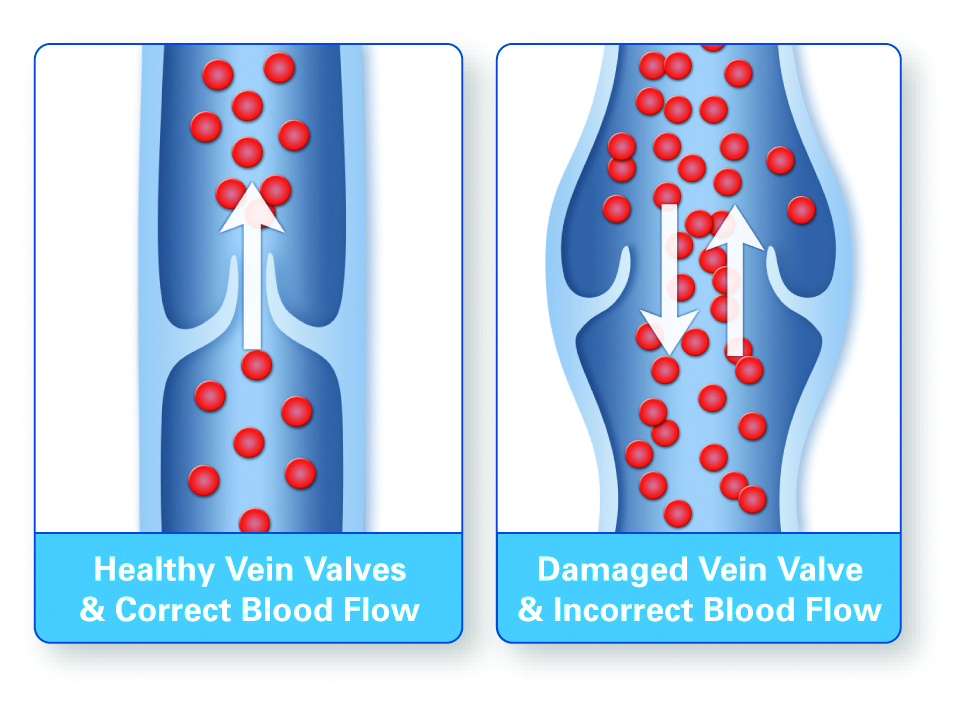 What Are Vein Valves? 2 healthy_and_diseased_valves