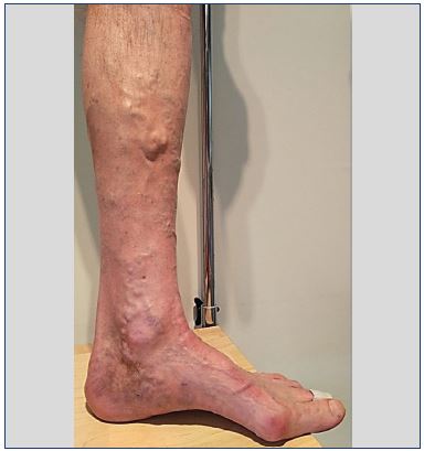 What Leg Venous Vein Ultrasound Can Uncover About Your Veins 3 Duplex ultrasound of the leg veins