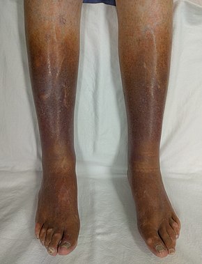 Stage 5. Chronic insufficiency