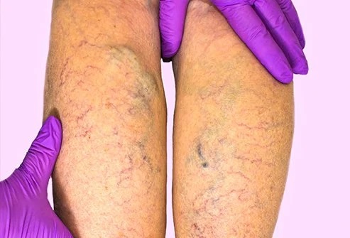 6 Stages of Venous Disease, Which Stage Am I? 2 venous disease is progressive and worsens over time.