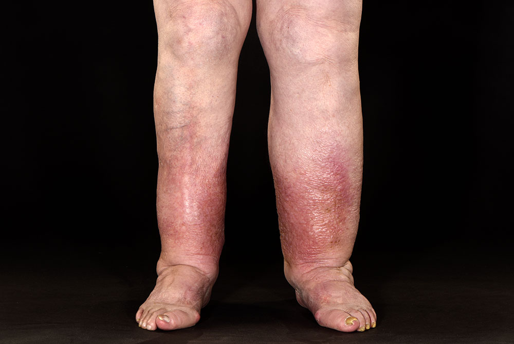 Stage 4. Venous Nodes - Edema venous insufficiency