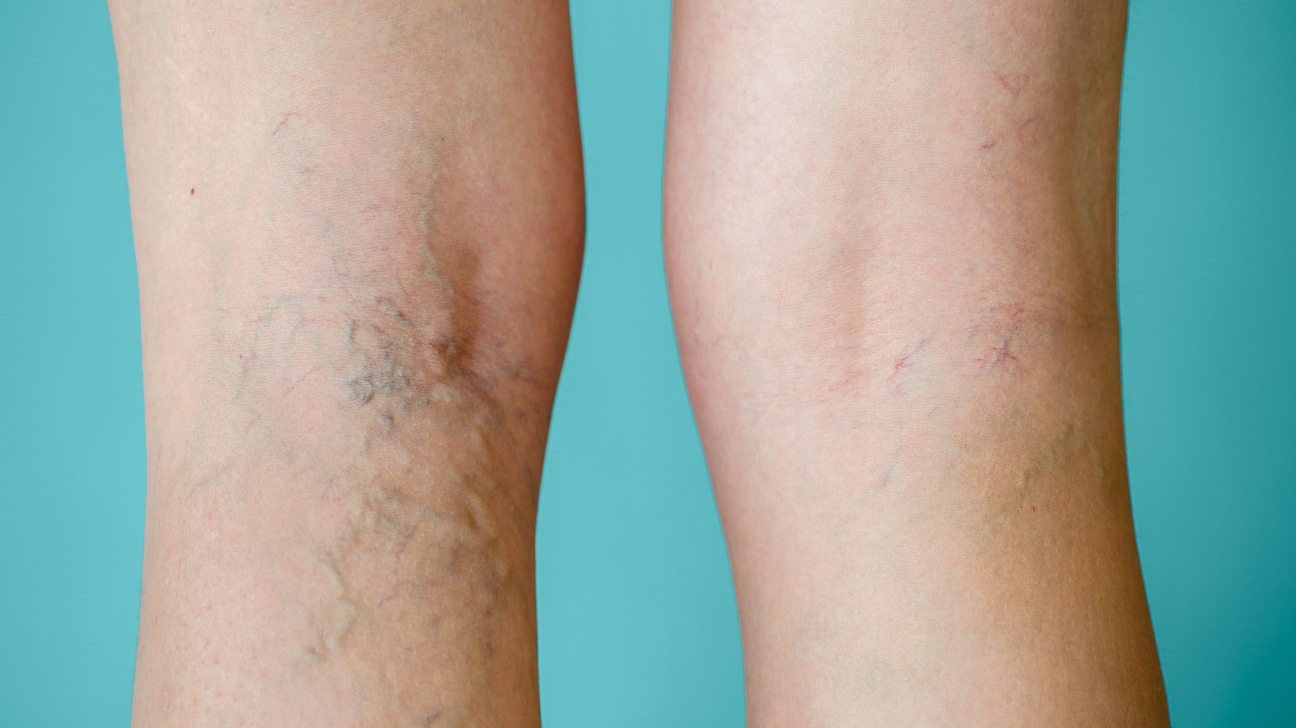 Stage 3. reticular veins and varicose veins