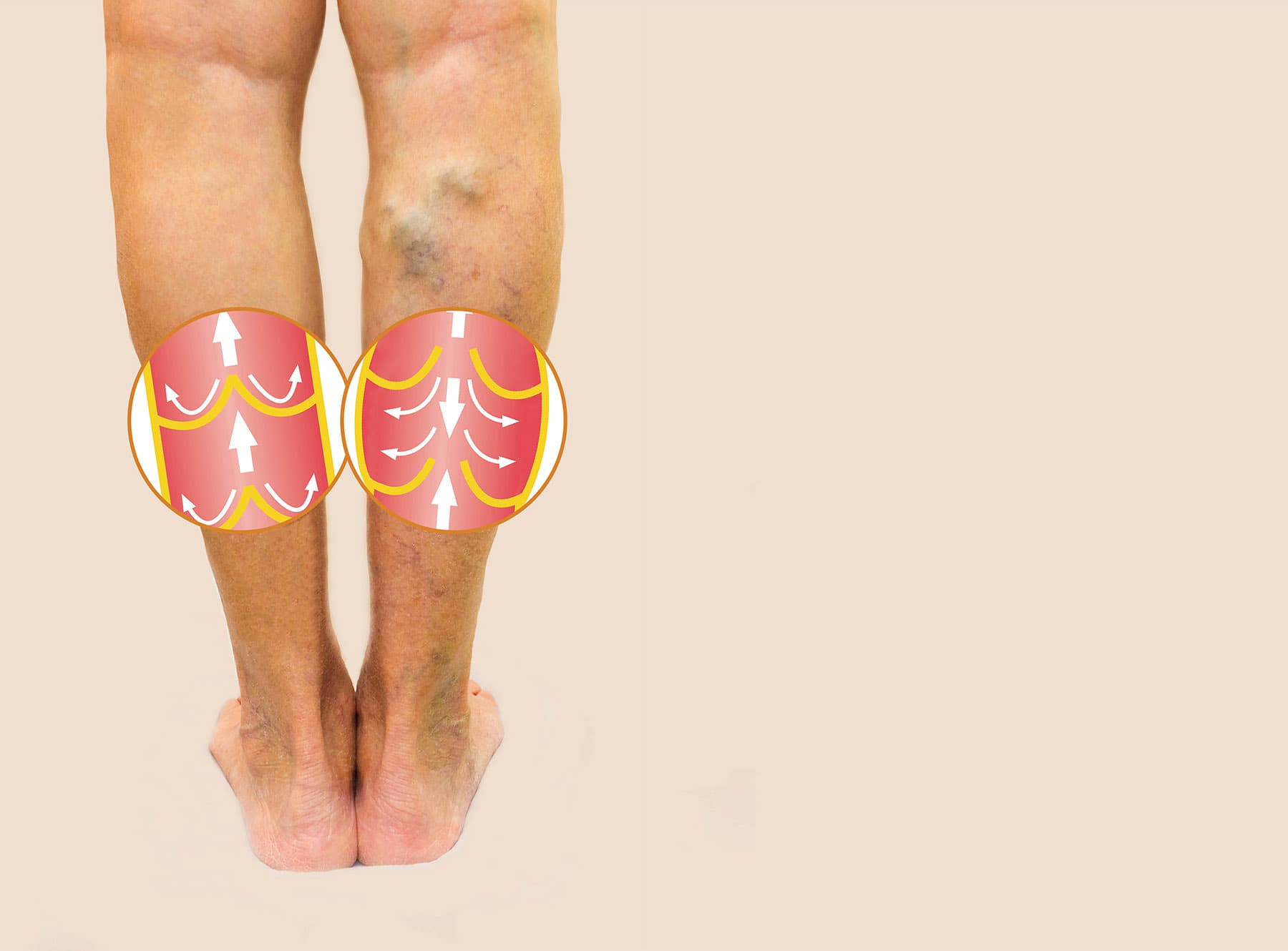 varicose-vein-valve-image-on-legs varicose-vein-valve-image-on-legs