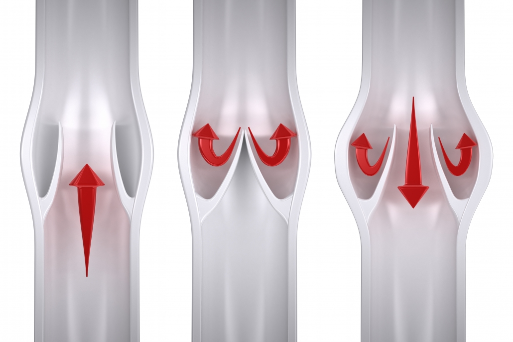 Leaky Valves In Legs Leaky Valves In Legs