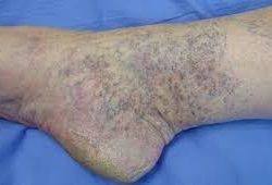 Untreated varicose veins Untreated varicose veins