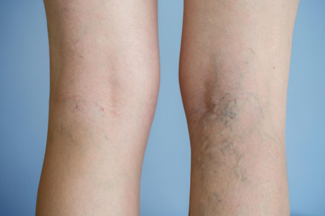 7 Signs of Venous Disease 1 symptoms