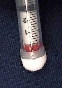 image of foam sclerosant