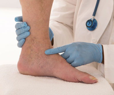 Varicose Veins