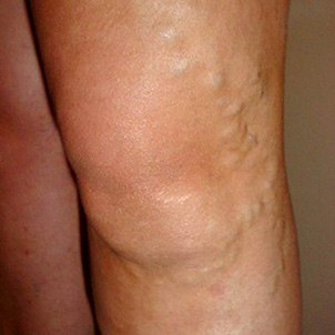 8 Warning Signs of Vein Disease: #1Tired, Heavy Legs 1 varicose veins