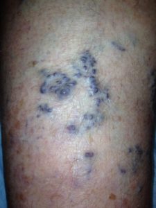 Spontaneous Vein Hemorrhage After Warm Shower
