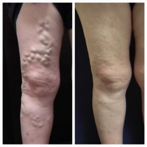 Before and After