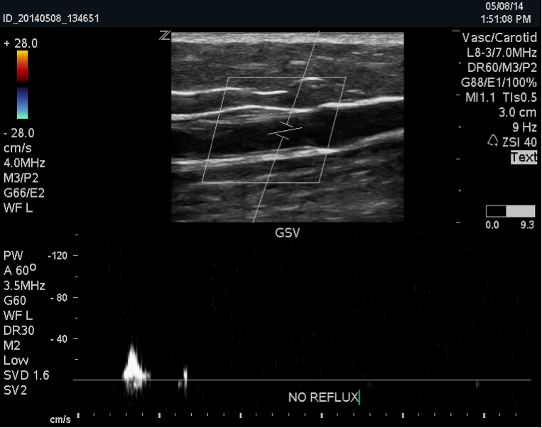 What If I need my Great Saphenous Vein for Bypass Someday? 1 GSV1