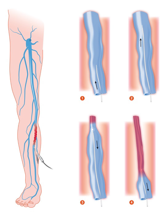 Diagram of endovenous laser ablation (EVLA) procedure