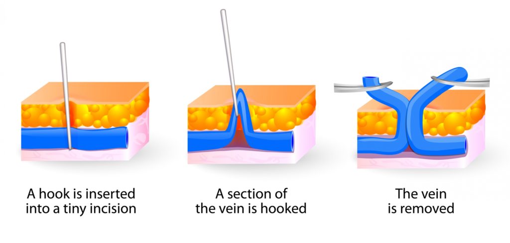 diagram of Phlebectomy procedure