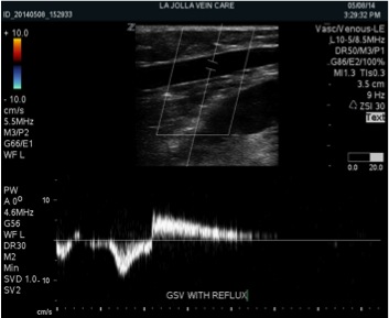 GSV with reflux