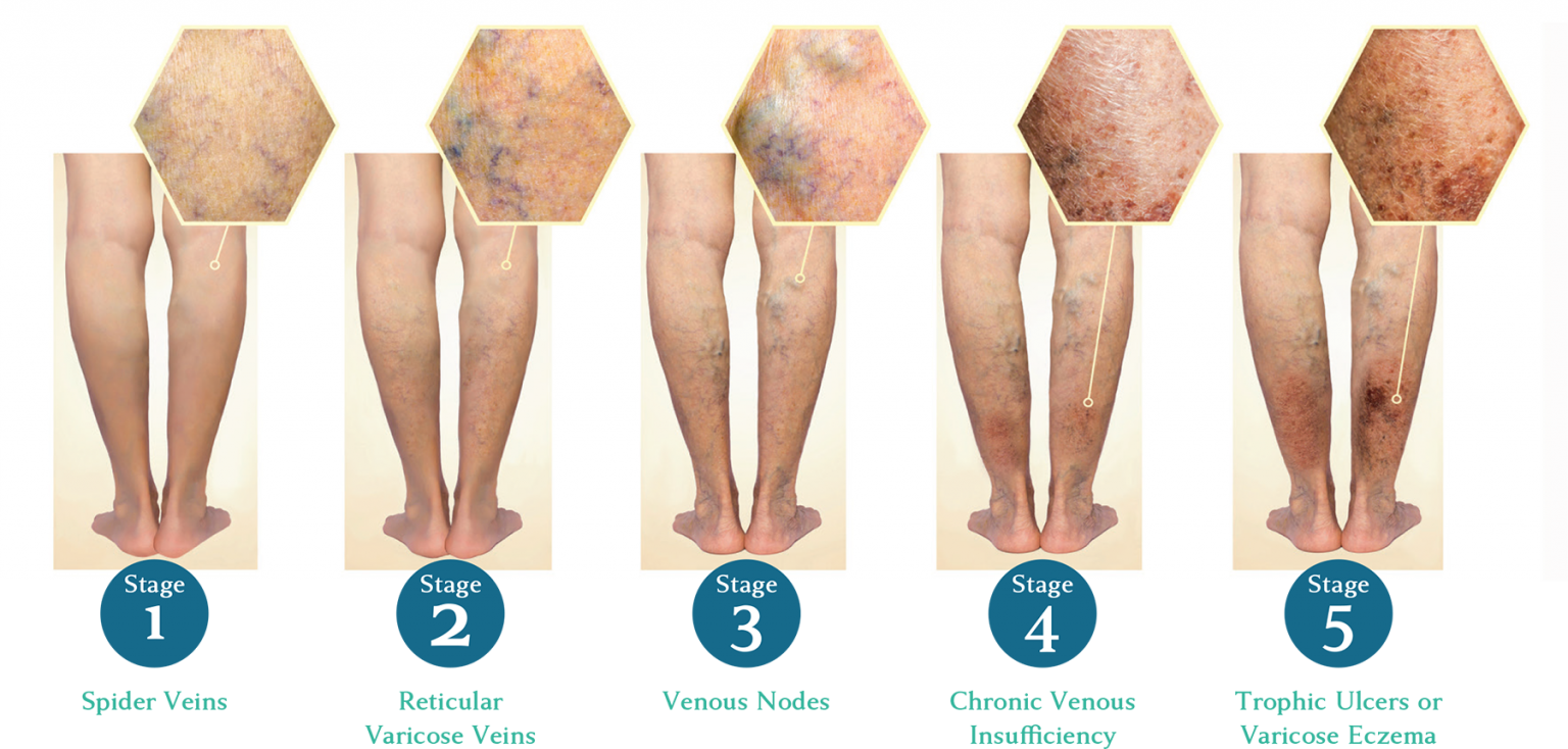 Image Showing Stages of Development of Varicose