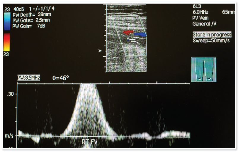 What is a Venous Duplex Ultrasound Examination? 1 Ultrasound Doppler Signals