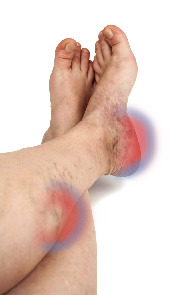 legpain-small leg pain-small