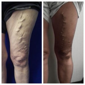 mom : daughter inherited varicose veins