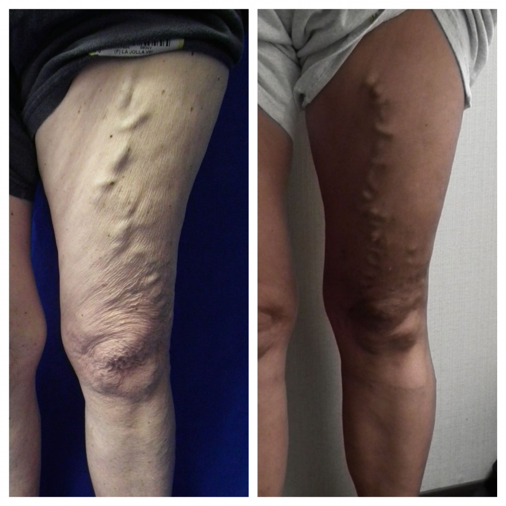 mom : daughter inherited varicose veins