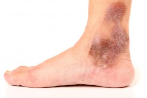 What is a Venous Insufficiency / Duplex Ultrasound Test? 1 Darkening of skin, and itchiness are a sign of chronic venous insufficiency or venous reflux disease
