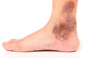 venous stasis