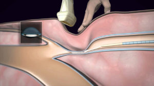 veinseal