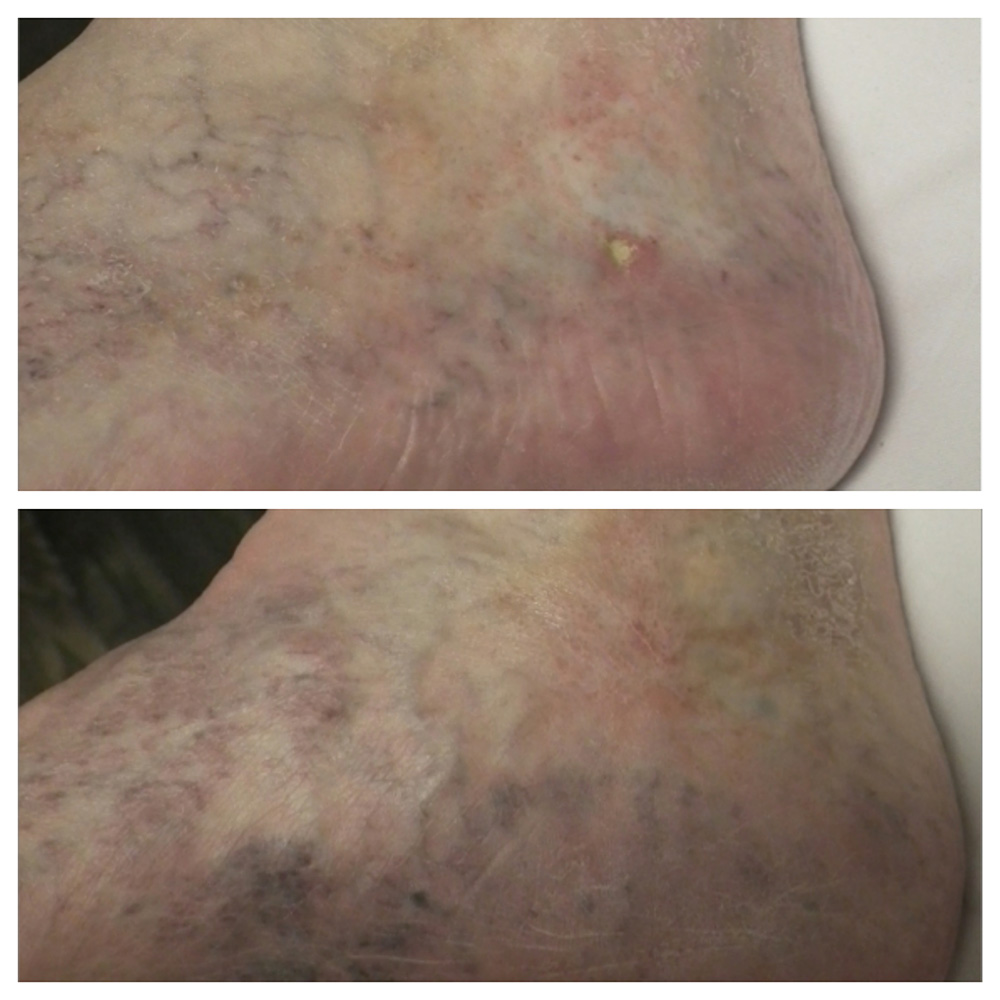 2-BA-VLU-ulcer-2_fotor