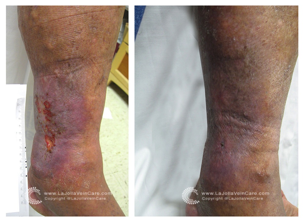Can Varicose Veins Cause Leg Ulcers? 1 ulcer-before-1