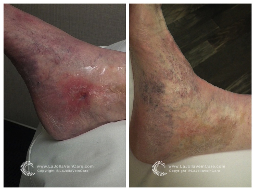 4-BA-VLU-ulcer-DSCF9906_fotor