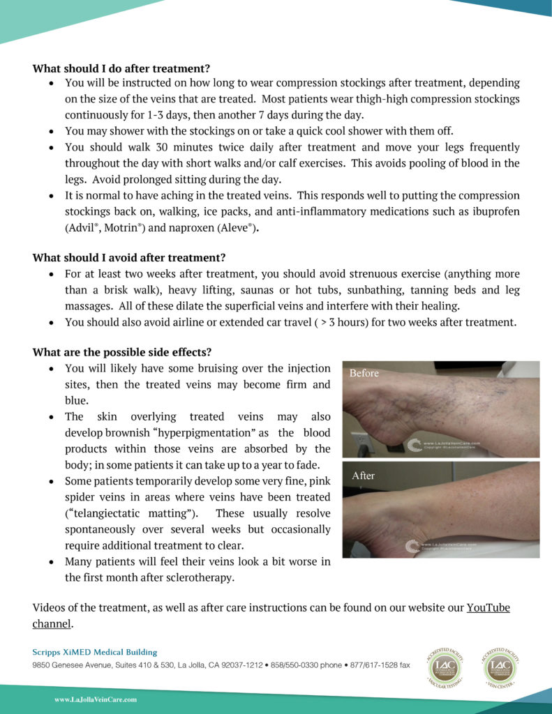 Spider Vein Treatment 2