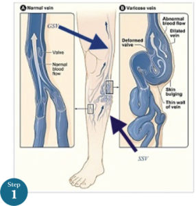 VD treatment step1