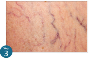 VD treatment step3