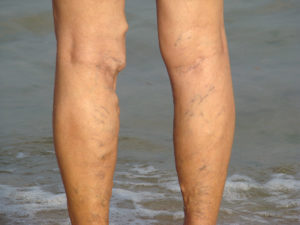 Vein Conditions Varicose Veins 10 Varicose vein in leg