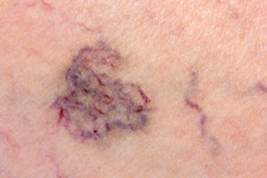 Spider Vein