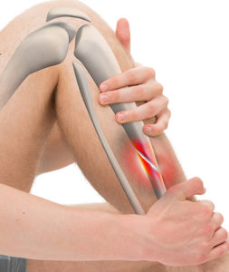 Leg Pain