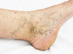spider veins around ankle