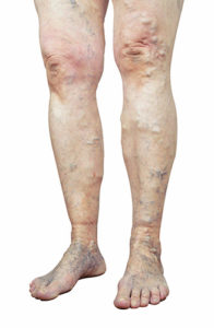 swelling of the ankles