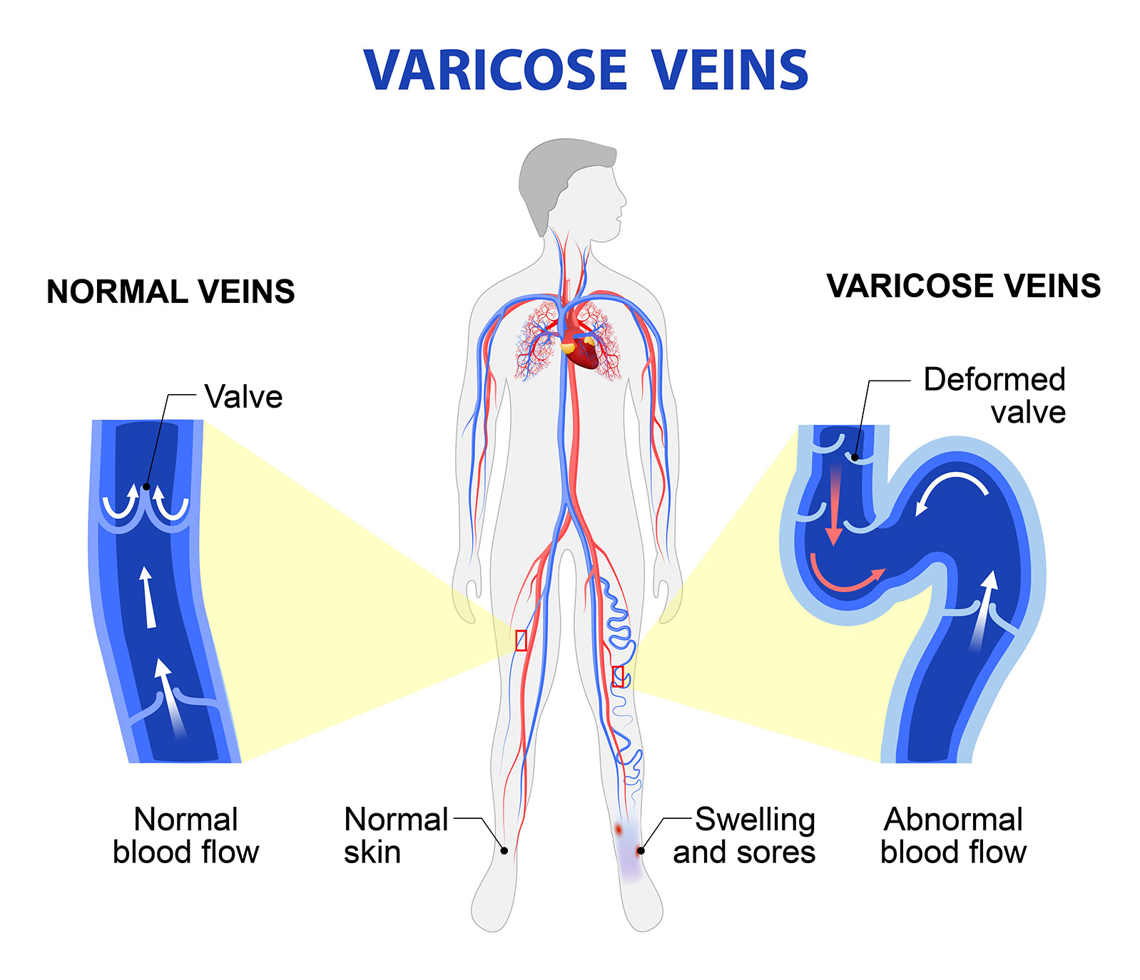 varicose veins infographic varicose veins infographic