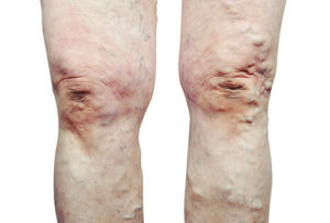 varicose veins spider veins
