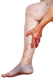 • aching throbbing or a feeling of heaviness in your legs