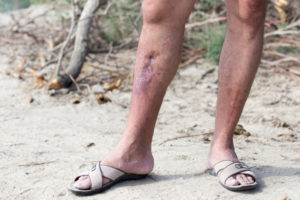 healed ulcer