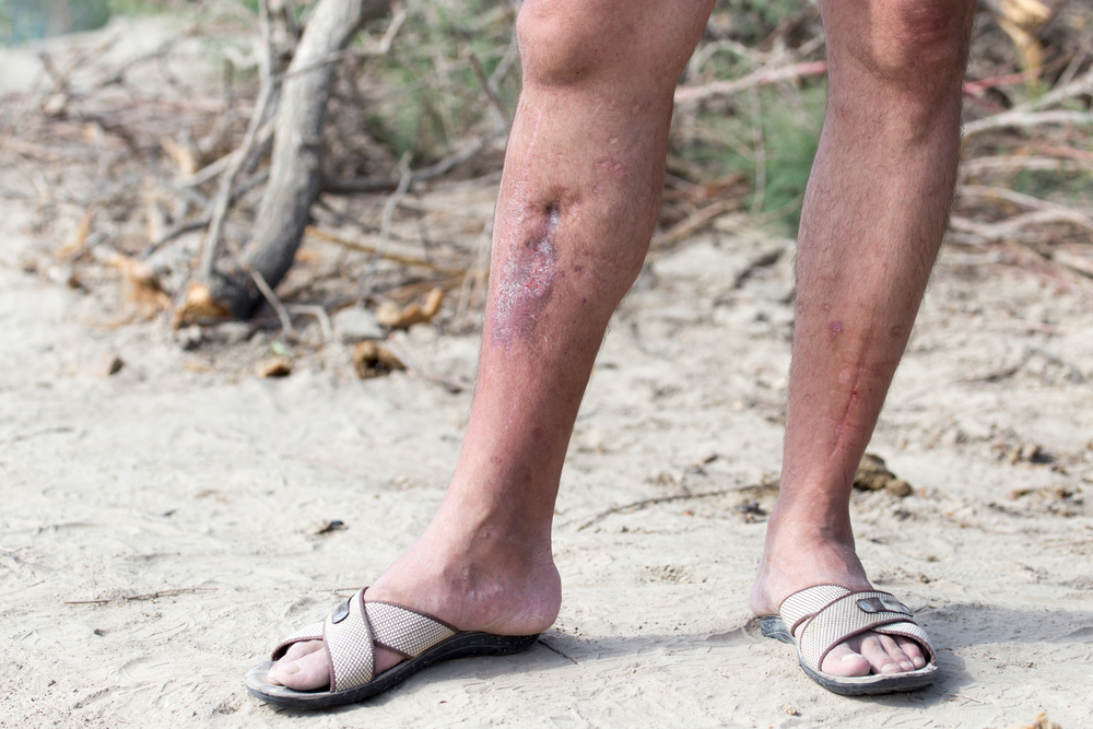 healed-ulcer healed-ulcer